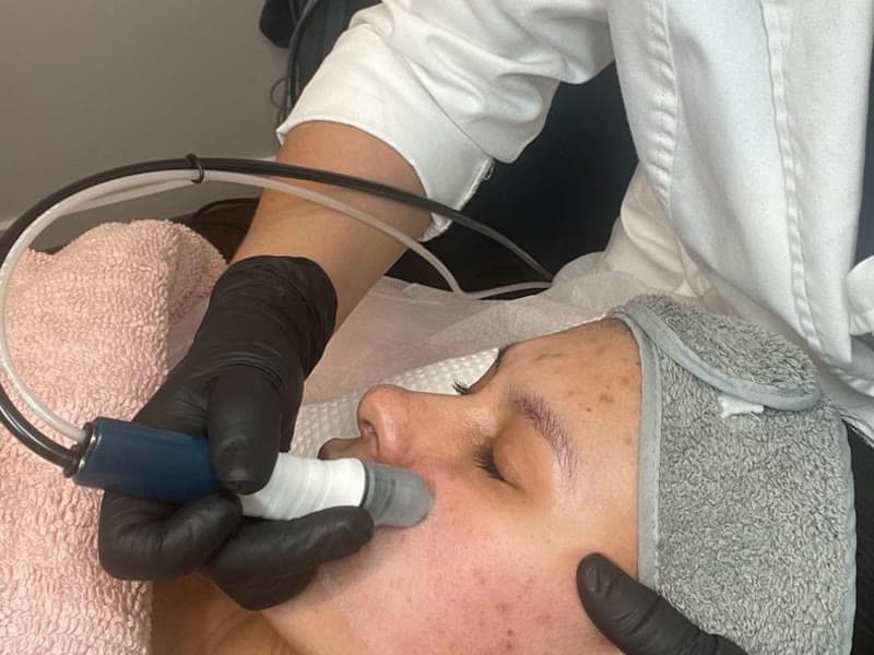 Microdermoabrasión Profunda (Derma-Pod Tech)