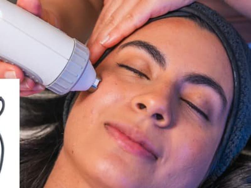 Full Face Lifting (Non-Invasive RF)