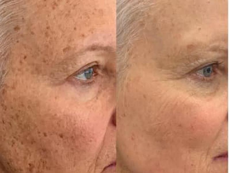 Sun Damage & Pigmentation — Large (Face, Neck, Décolleté)